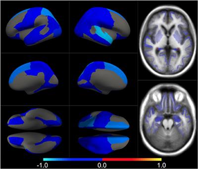 Projection to Latent Spaces Disentangles Pathological Effects on Brain Morphology in the Asymptomatic Phase of Alzheimer's Disease